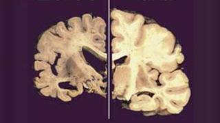 Prueban ‘marcapasos’ cerebral contra el Alzheimer
