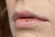 Carcinoma en el labio: ¿cuáles son los síntomas y posibles tratamientos de este tipo de cáncer?