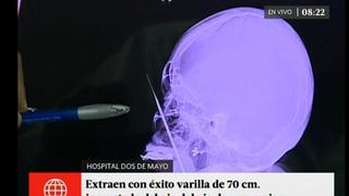 Extraen varilla de 70 cm que ingresó por debajo del ojo de una mujer