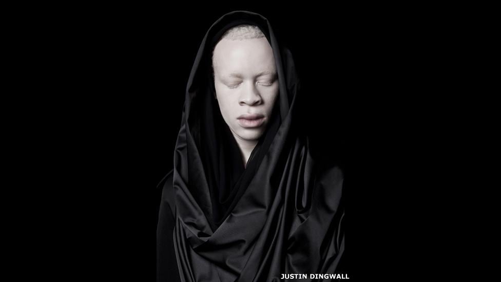La cuestionada belleza de los albinos - 2