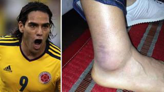 FOTO: Radamel Falcao mostró “herida de guerra” del duelo ante Perú
