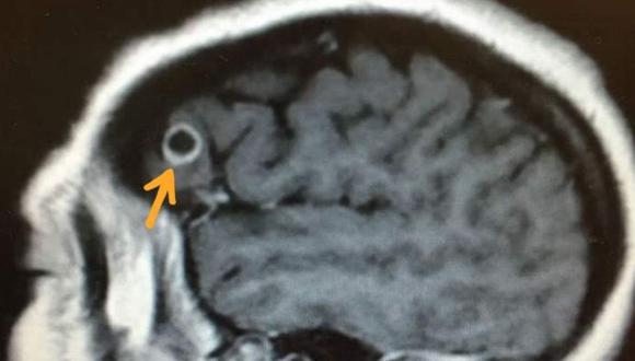 Fue impactante": le abrieron el craneo para extirparle un tumor y  encontraron una tenia en su cerebro | TECNOLOGIA | EL COMERCIO PERÚ