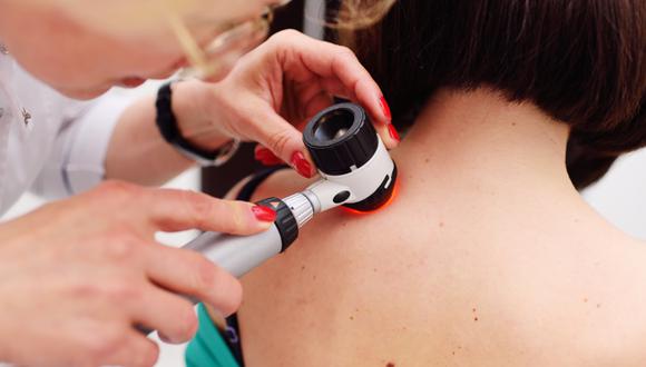Realizarse una revisión de lunares es importante para prevenir o detectar un cáncer de piel. (Foto: iStock)